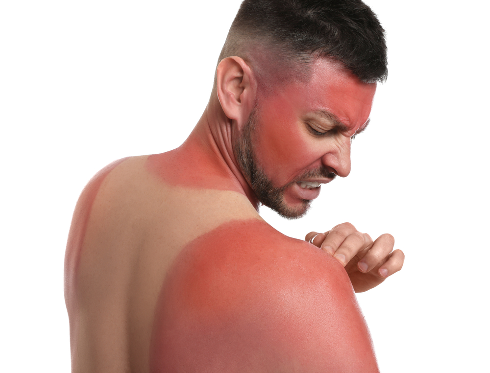 Sunburn can sometimes be dangerous